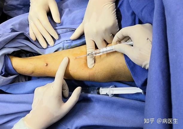 动静脉内瘘套管针穿刺基本技巧