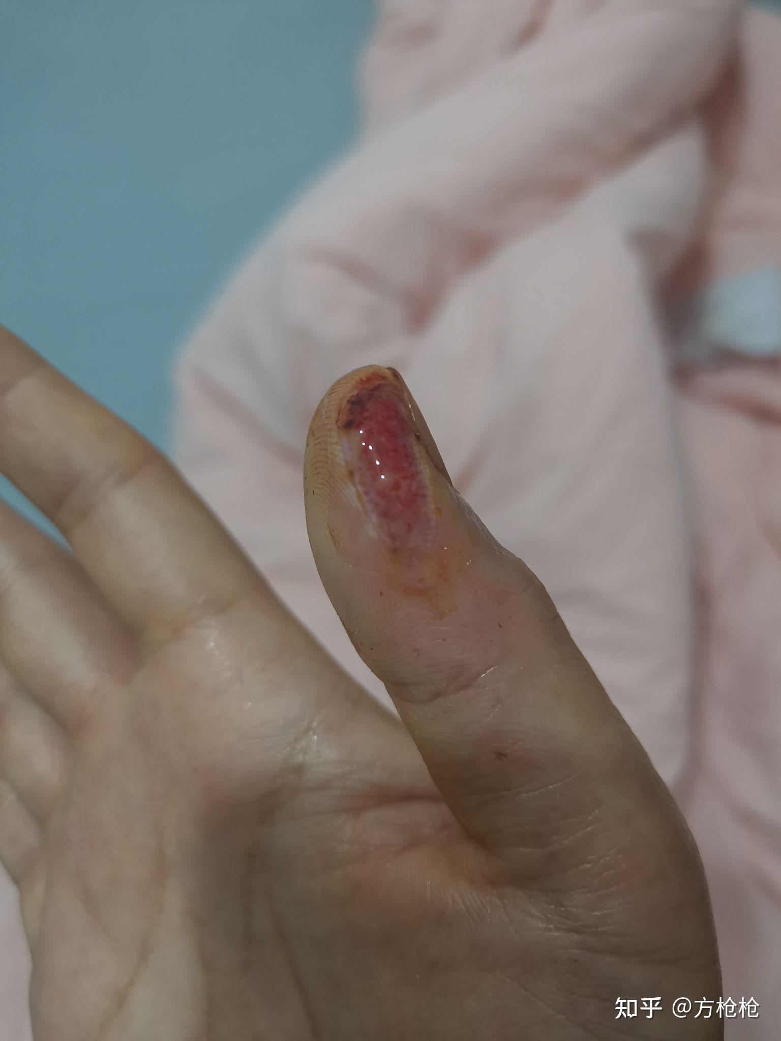 手指被切下一块肉,多长时间能恢复? - 知乎