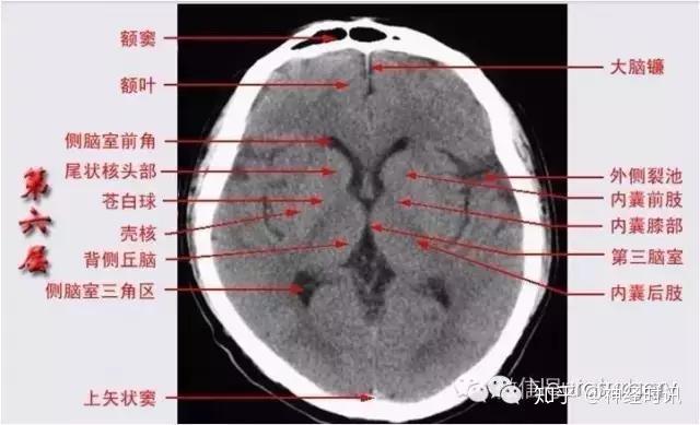 解剖&影像 —— 颅脑CT解剖口诀及彩色解剖图 - 知乎