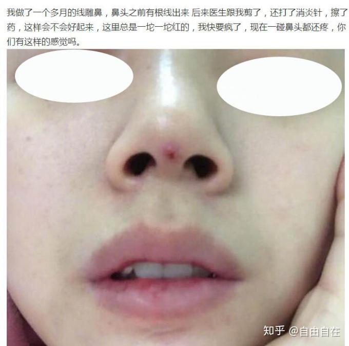 那些线雕隆鼻失败的鼻子最后怎么样了