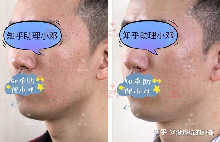 厢车型痘坑冰锥型痘坑做了点阵激光两组后的效果呈现