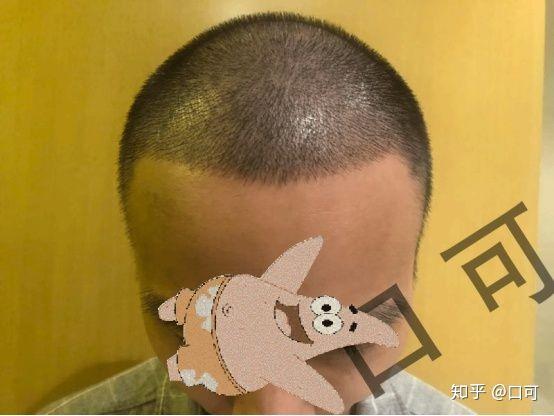 ynp植发多少钱(碧莲盛植发医院植发官网)