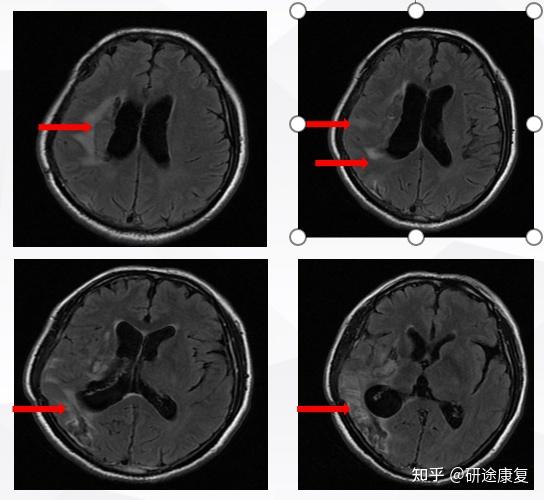 知识分享 | 交叉性失语患者病例分享 - 知乎