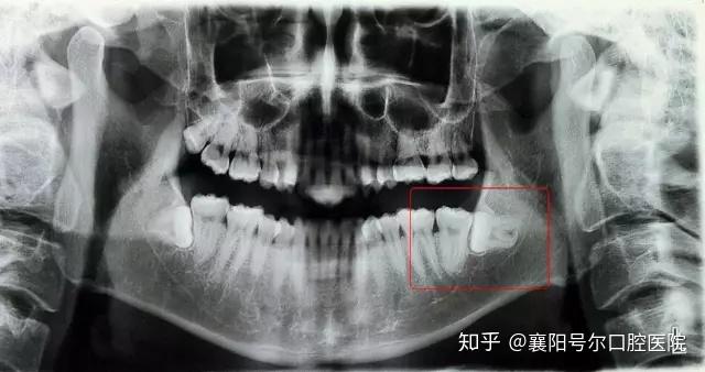 襄陽號爾口腔醫院醫生溫馨提示:拔智齒的時間和費用阻生齒可以粗略分