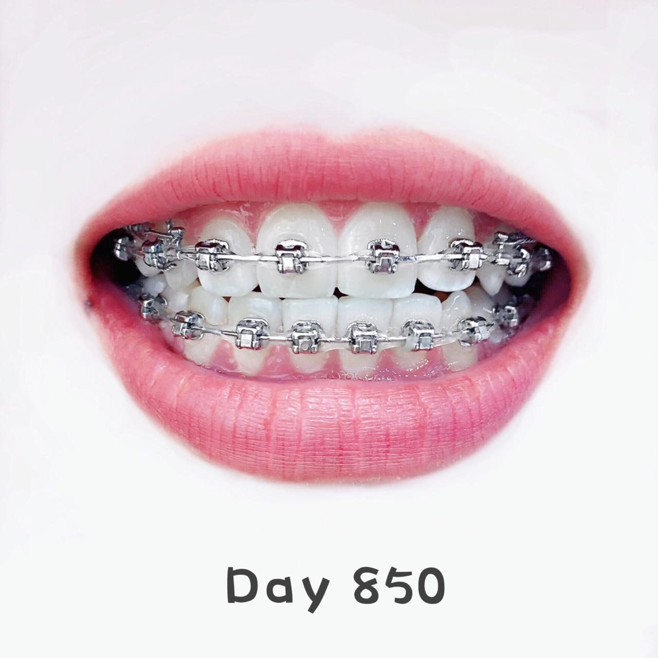 戴牙套(正畸)是什么体验? - 知乎