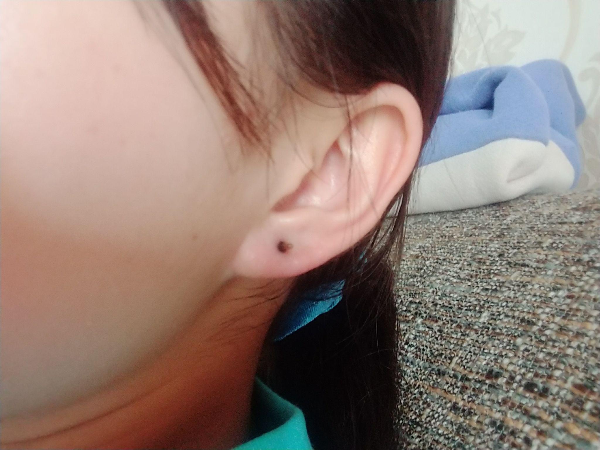 打耳洞后耳洞周围发黑怎么办