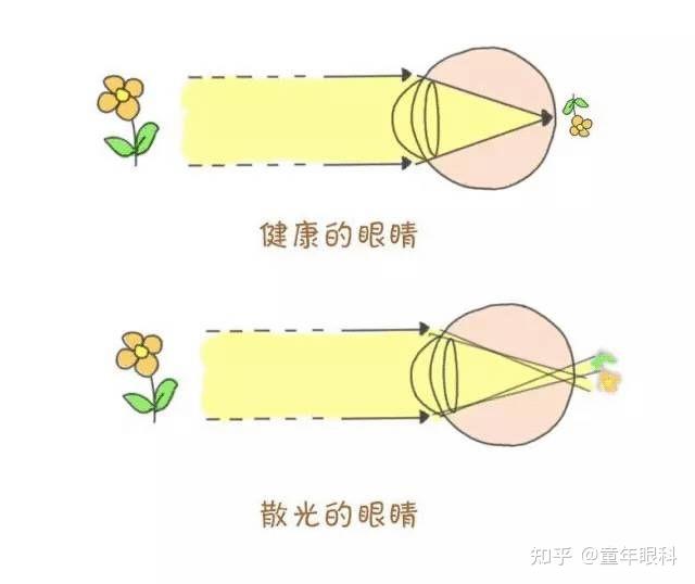 北京房山童年眼科散光的症状