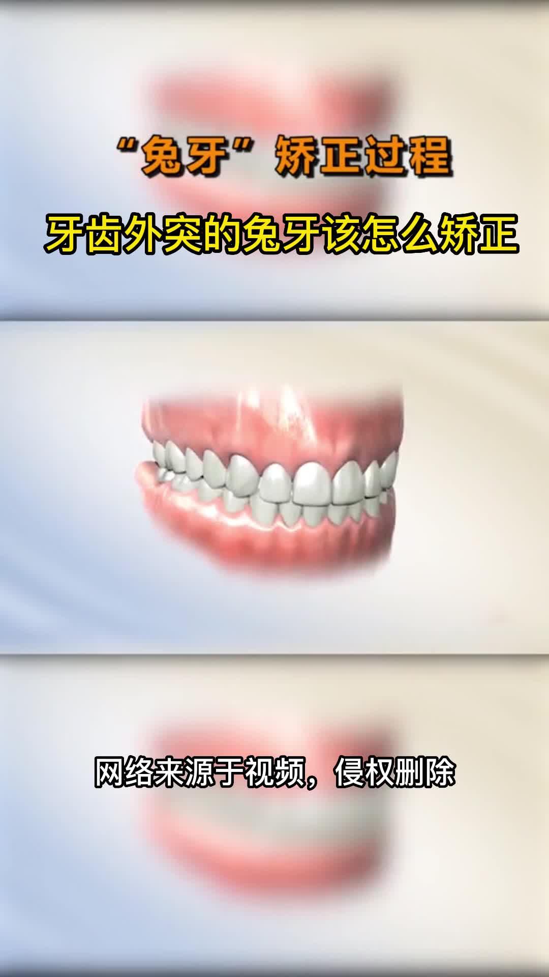 牙缝大？门牙突？说明该做牙齿矫正了！#上海 - 知乎