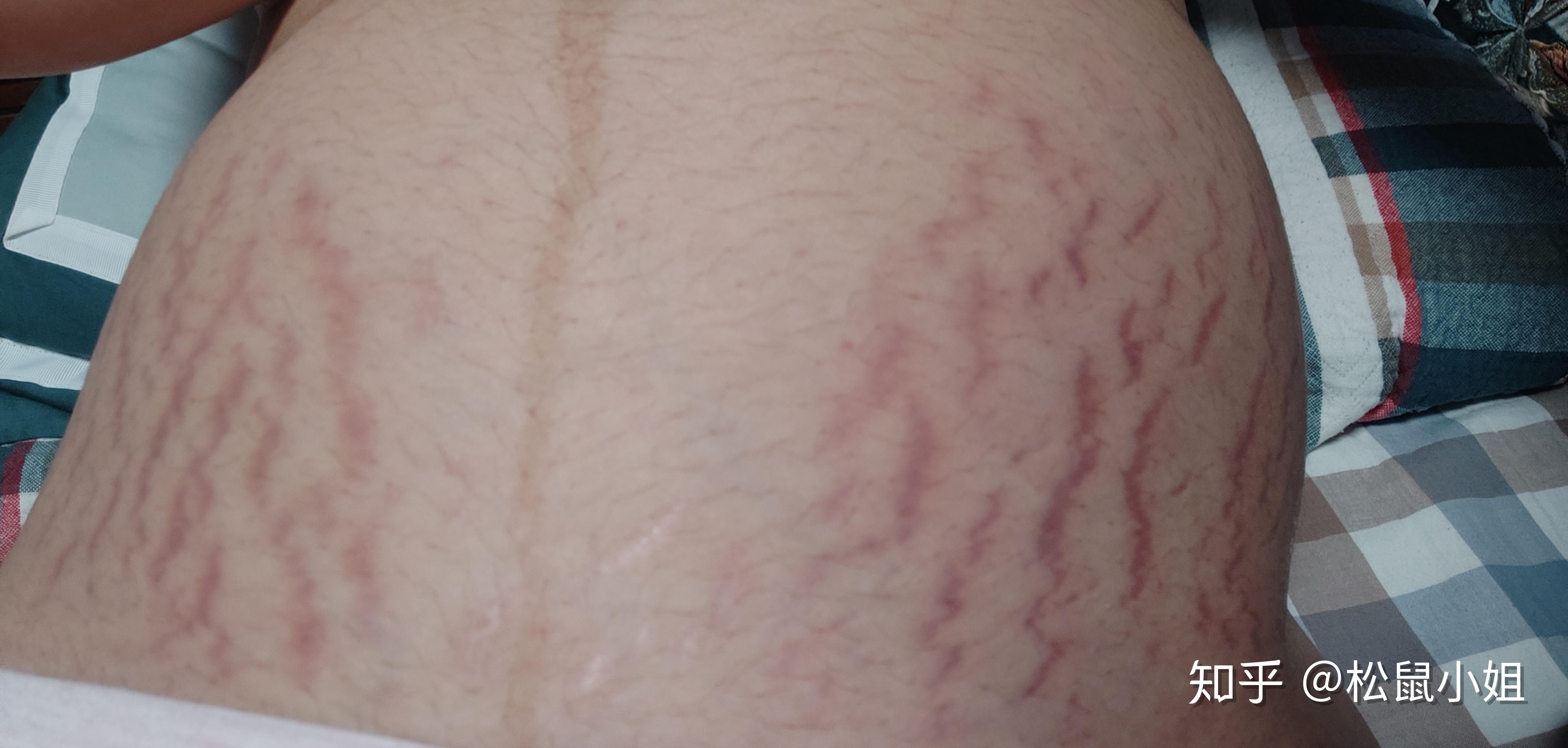 男人们会介意自己的老婆生完孩子之后的妊娠纹吗