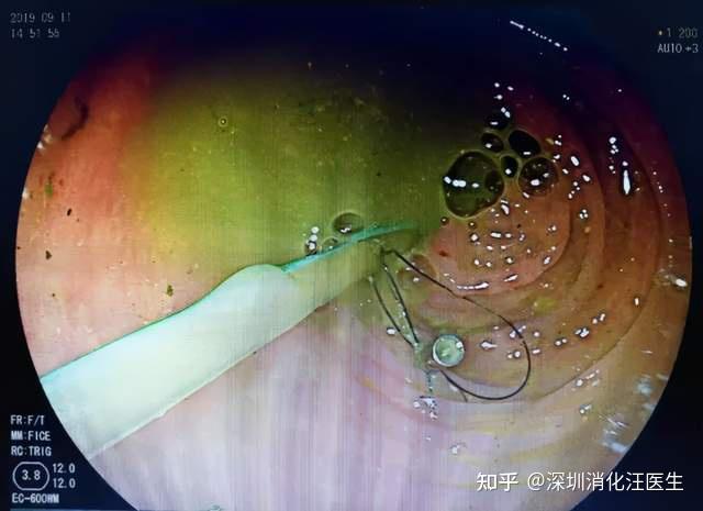 经肠镜回盲部置管注入菌液 一般隔天注射1次,3天后管子可自行拔除