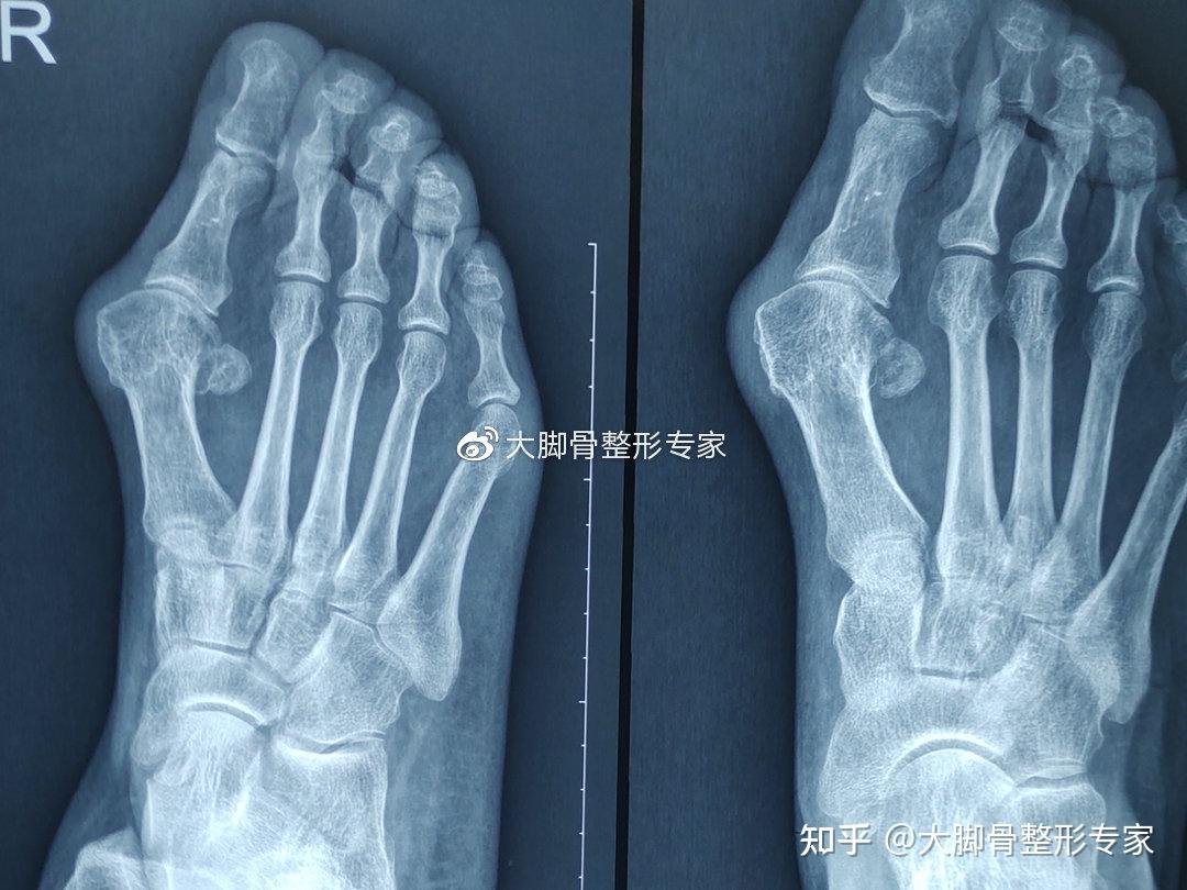 的籽骨复位或者切除,拇收肌腱从头第一趾骨基底移位至第一跖骨头外侧