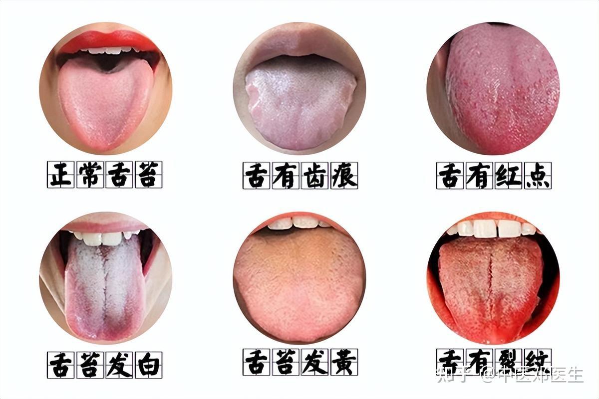 【实践分享】舌苔白厚、黑舌苔、地图舌、裂纹、锯齿、齿痕、肥大、舌下青筋、口疮溃疡、唇色 | 安疗网