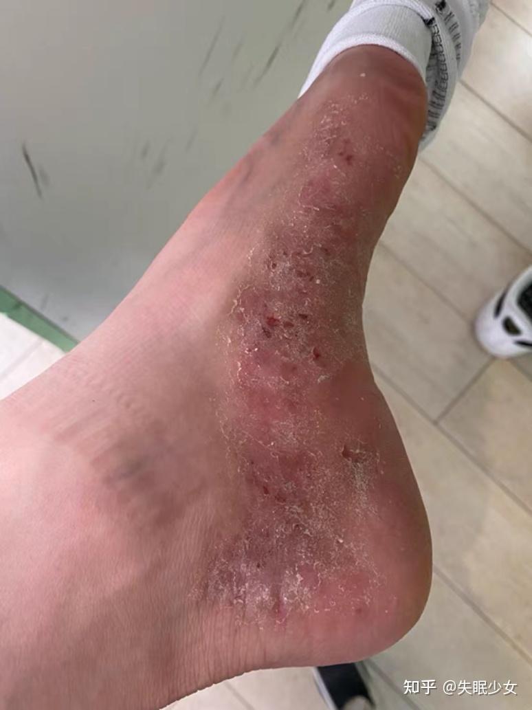 混合型脚气怎么治疗? - 知乎