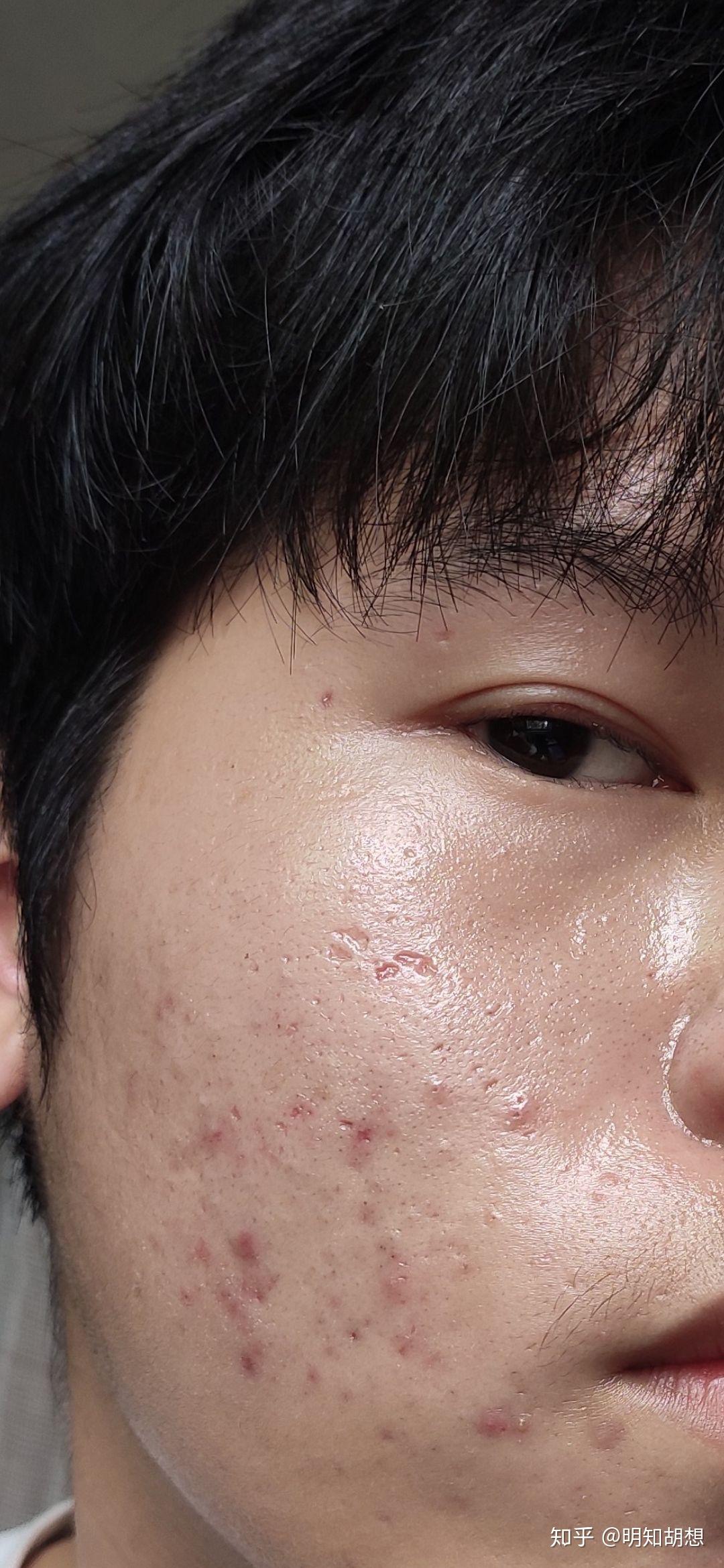 凹陷性痘坑怎么才能修复