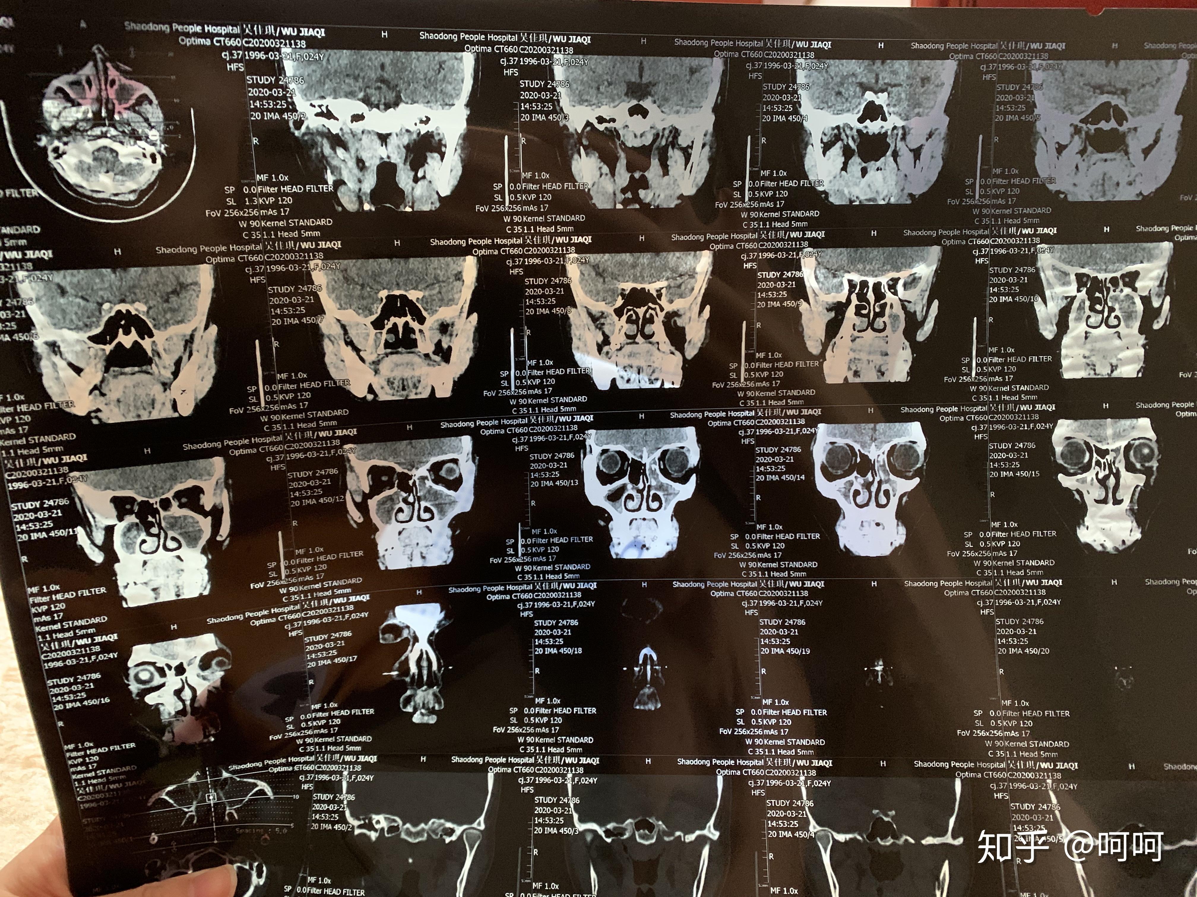 上頜竇炎篩竇炎和蝶竇炎醫生開了兩種藥物桉檸蒎腸溶軟膠囊還有糠酸莫