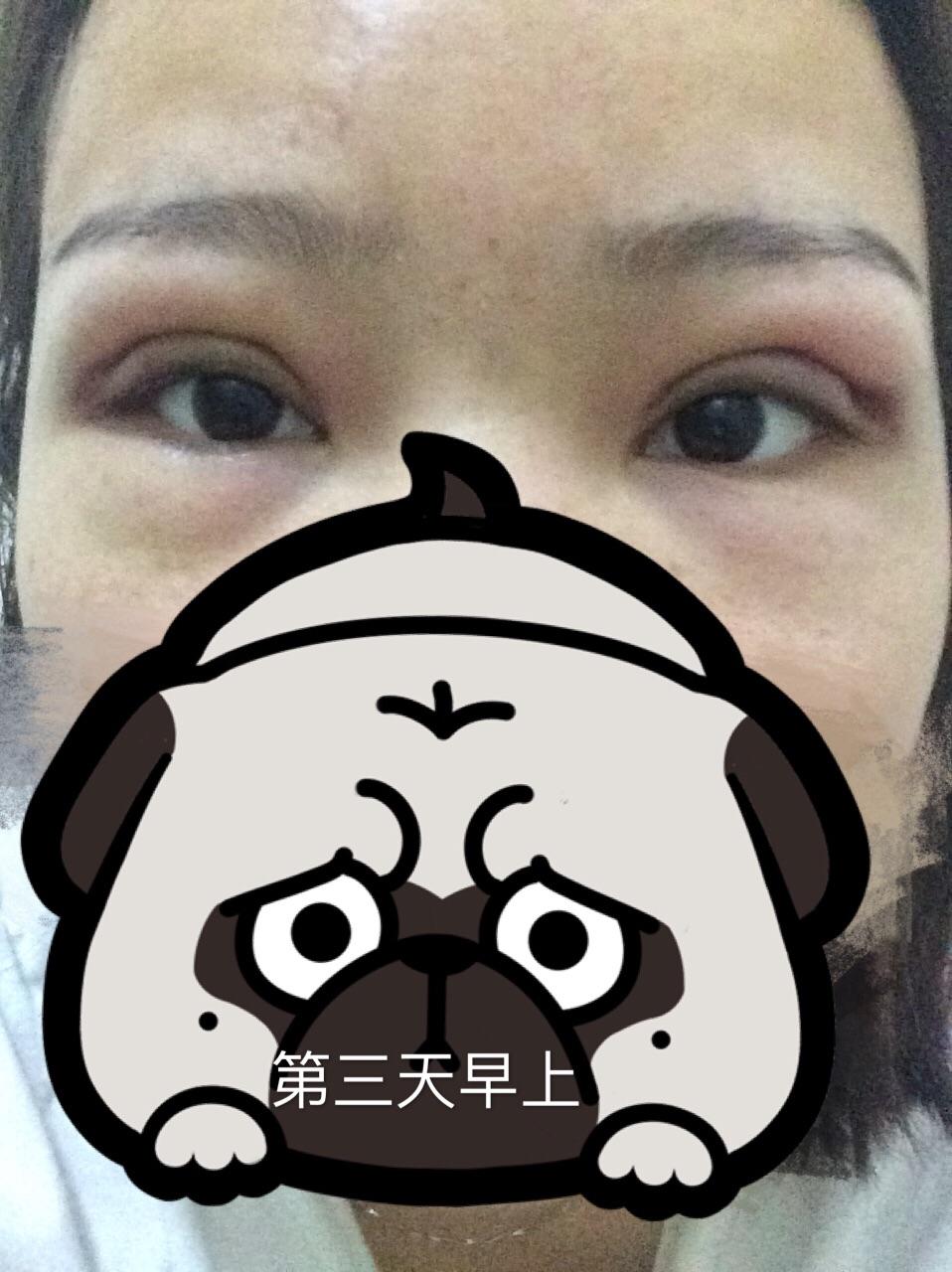 埋线双眼皮能保持多久?