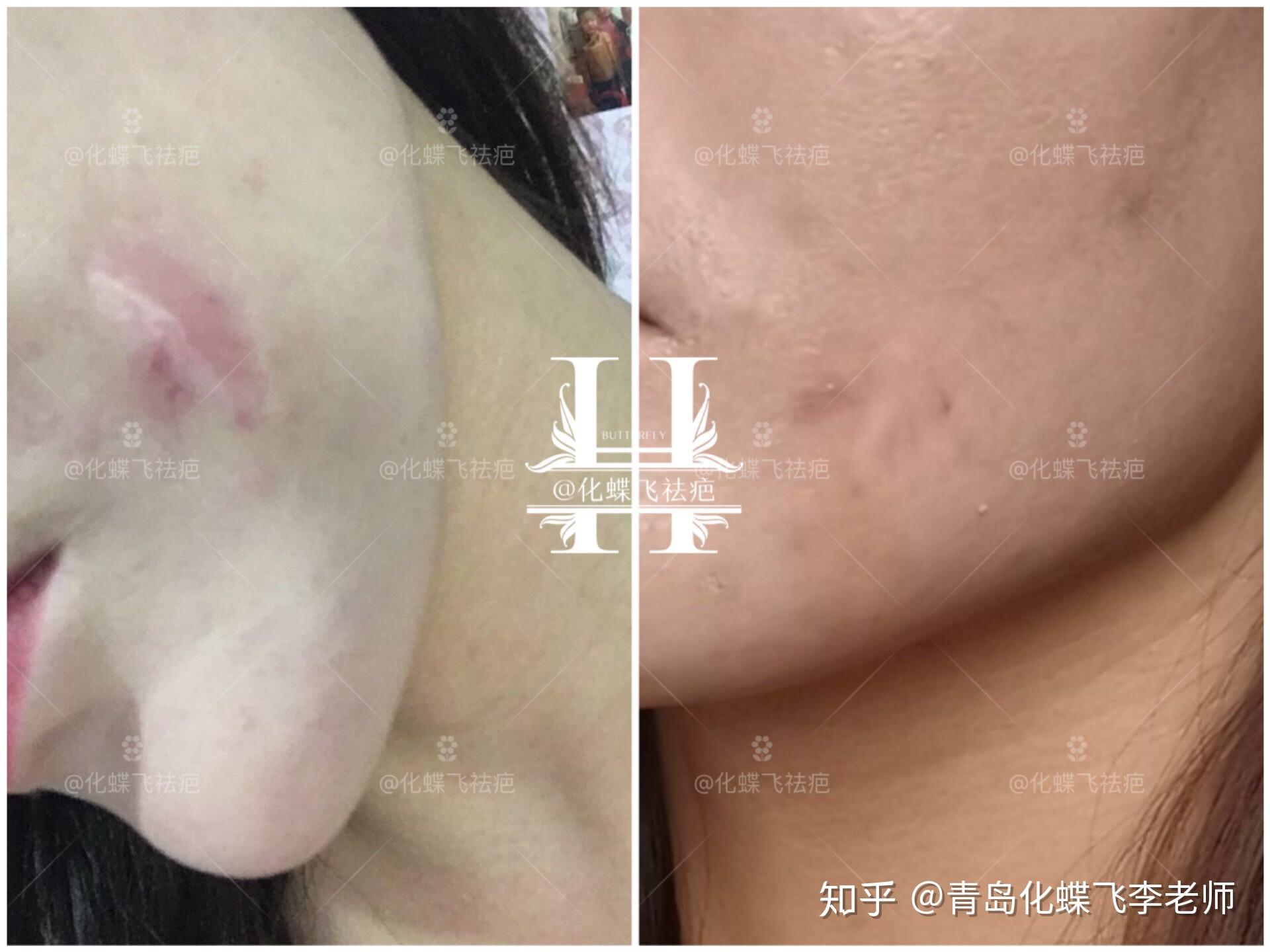 北京小姐姐的增生疤痕全平啦