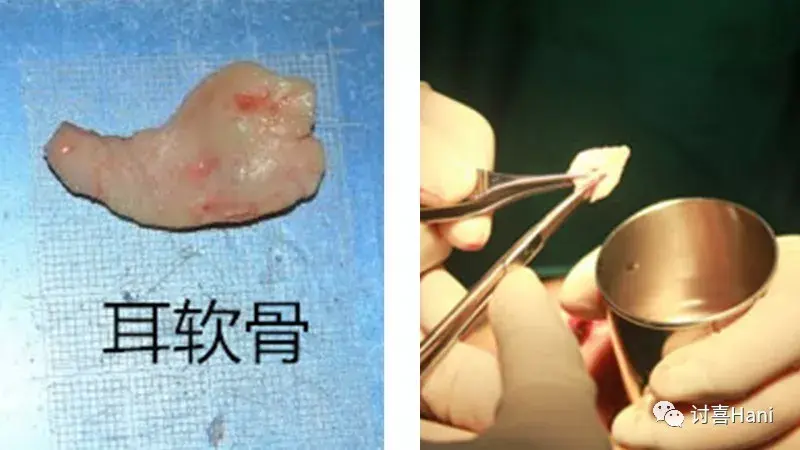 讨喜hani异体骨是死人骨头隆鼻的吸收率高到吓人