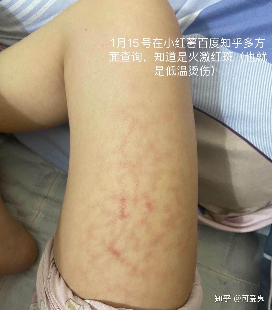 电暖风烫伤腿上起了一片像大理石纹一样的斑纹哪位同学有过同样经历