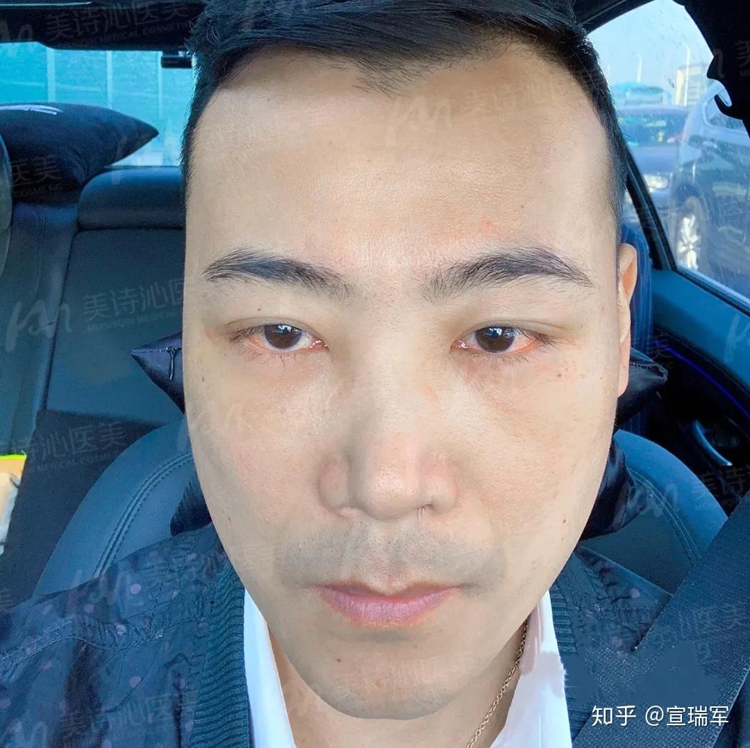 眼袋大面中凹陷的脸该如何改善? - 知乎