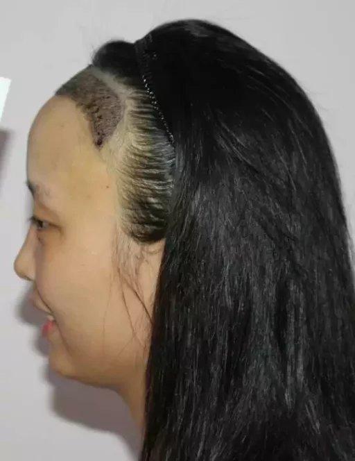 种植发际线安全吗,为什么几乎没见过女明星做
