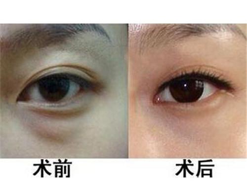 去眼袋手术效果能维持多久 知乎 去眼袋手术效果能维持多久 知乎