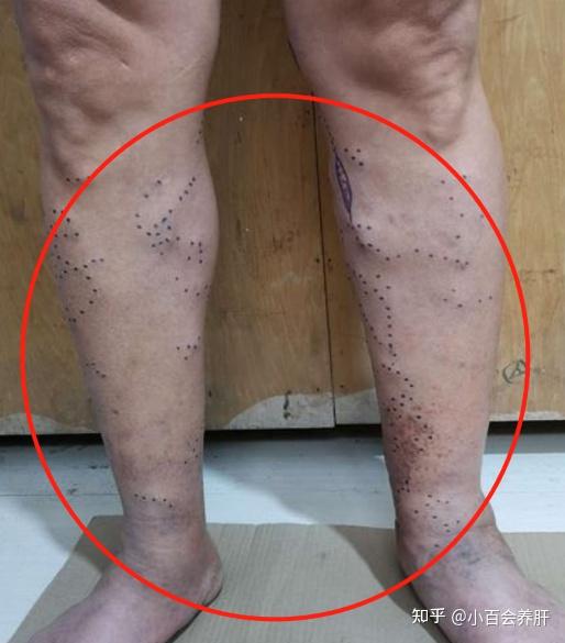 静脉曲张怎么办7个等级自测一下