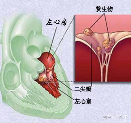 手把手教你如何理賠重疾第三期嚴重感染性心內膜炎