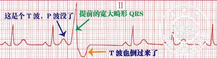 有完全性的代偿间歇t波与qrs波群主波方向相反其前无相应的p波提前