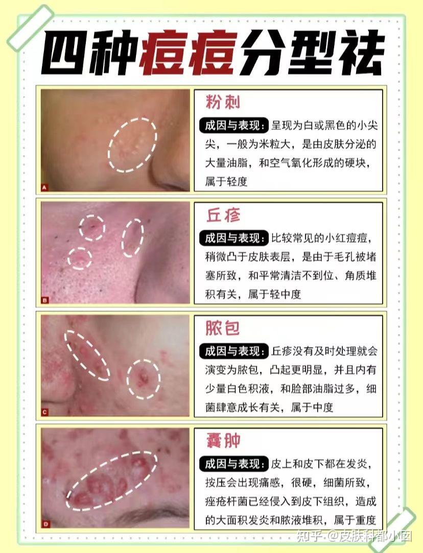 (2022)皮肤科医生教你正确战胜痘痘!祛痘、去痘印的干货分享!痘肌护肤流程不花冤枉钱! - 知乎