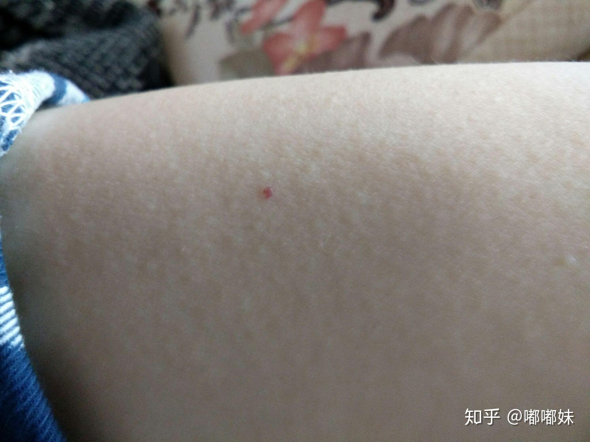 正常红痣的图片原因,蜘蛛痣,区别_大山谷图库