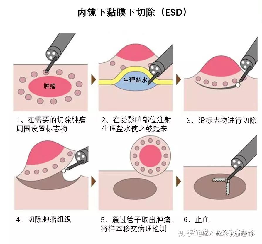 胃癌手术 图解图片