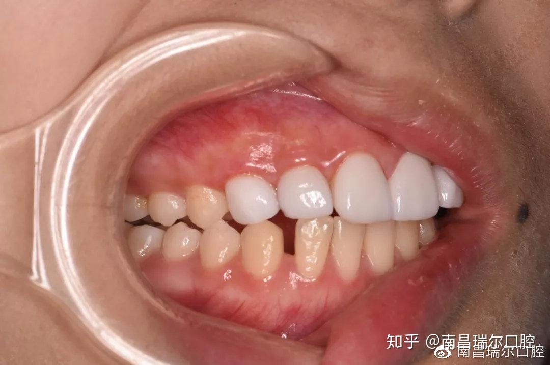 病例报告第3期门牙缝大漏财还毁颜值牙医如何逆天改命快速关缝纳财