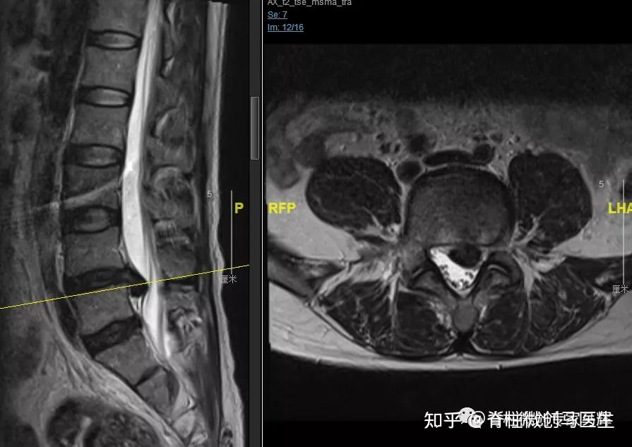 都是腰椎間盤怎麼你就那麼突出