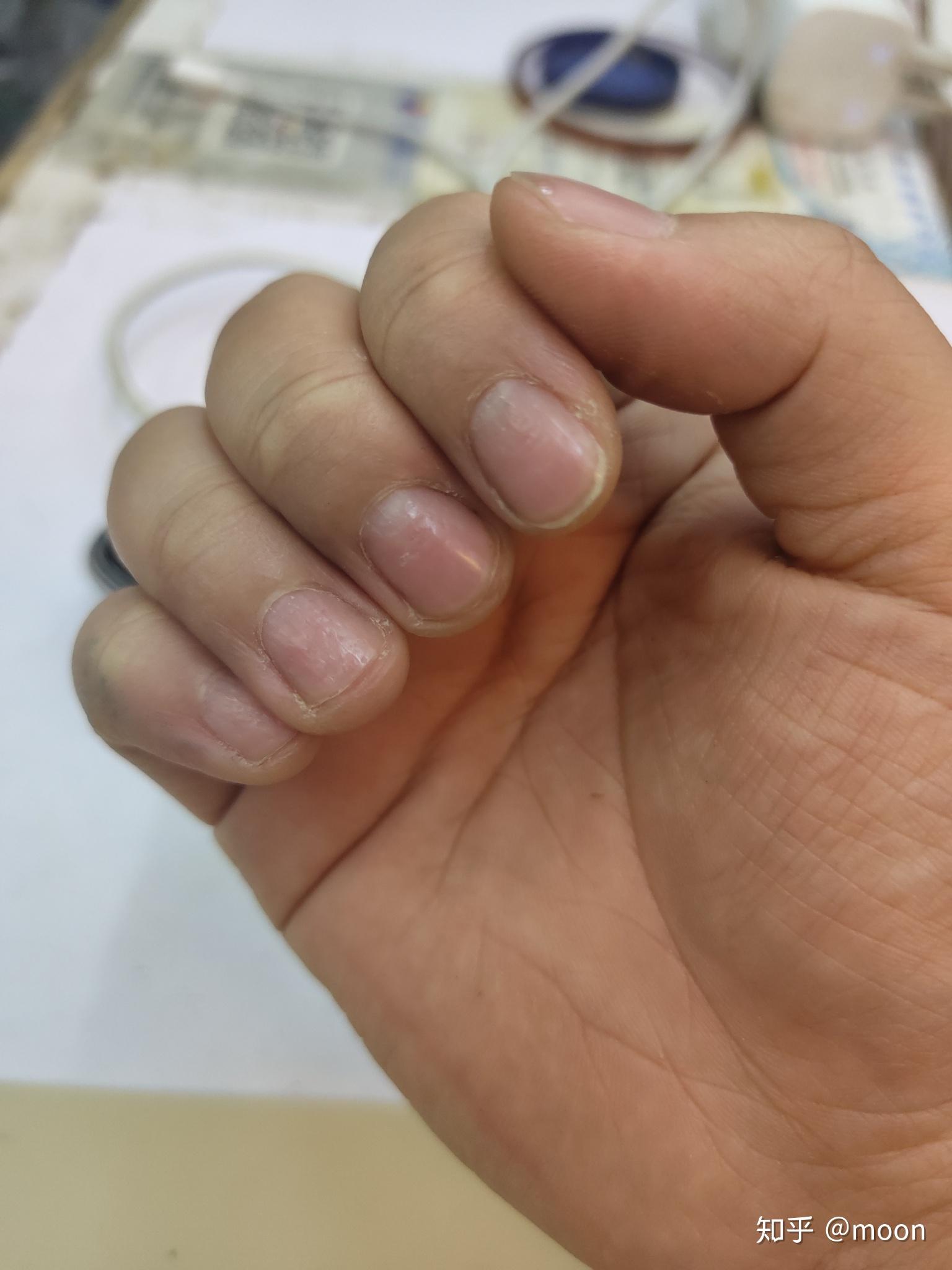 手指甲上全是小坑是怎么回事呢? - 知乎
