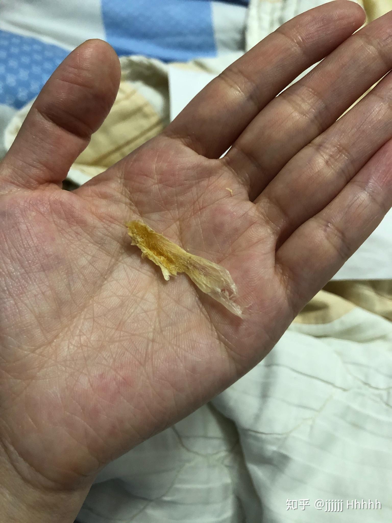 耳屎最大能有多大