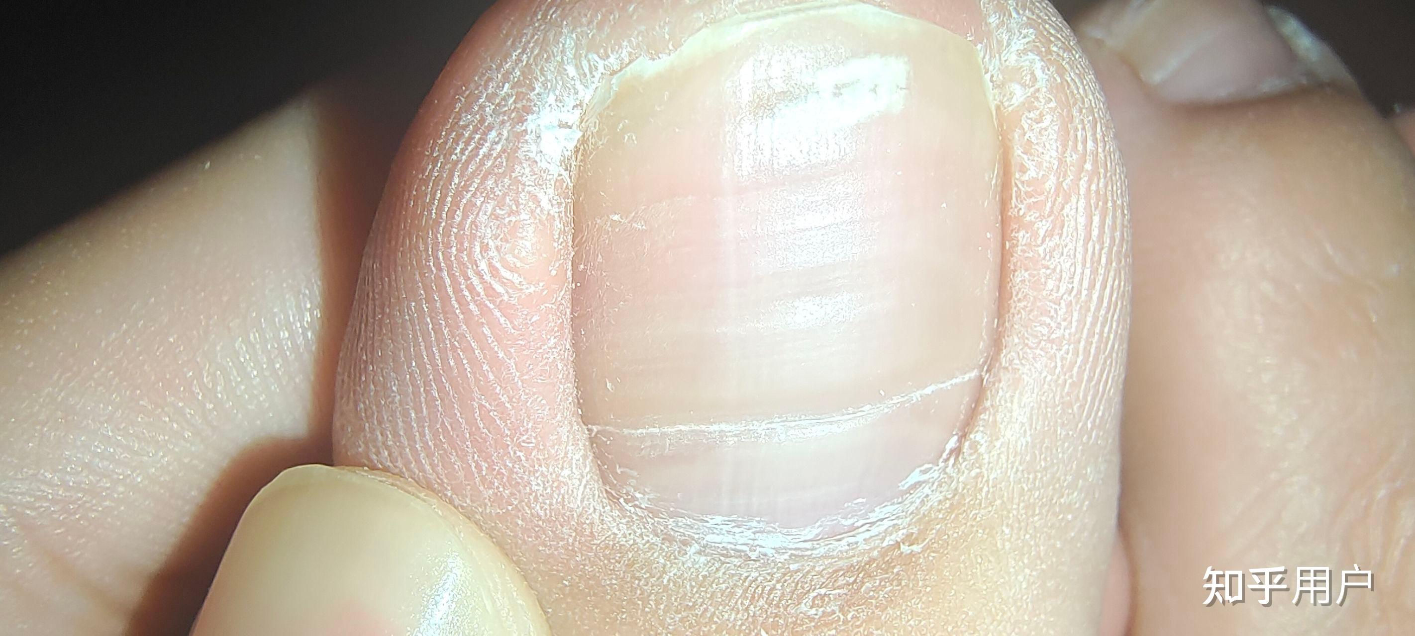 大脚趾甲有一条特别深的横纹,看起来跟裂开了一样,想请教一下这是怎么