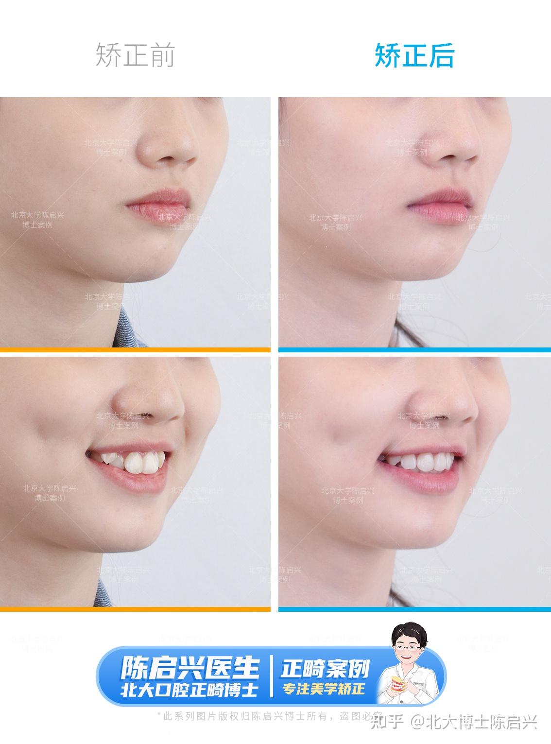 女生的牙齿从拥挤不齐变得整齐美观,咬合改善了,上下牙齿中线对齐