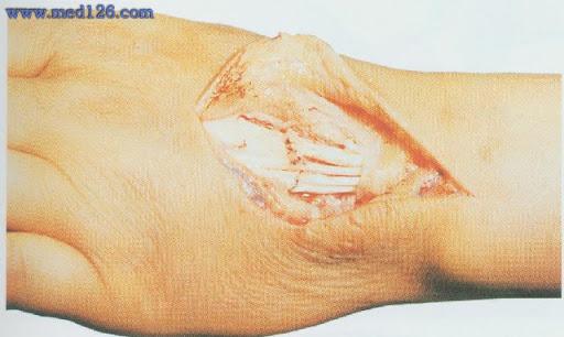 伸指肌腱损伤多为开放性,以切割伤较多,常合并神经血管伤或骨关节损伤