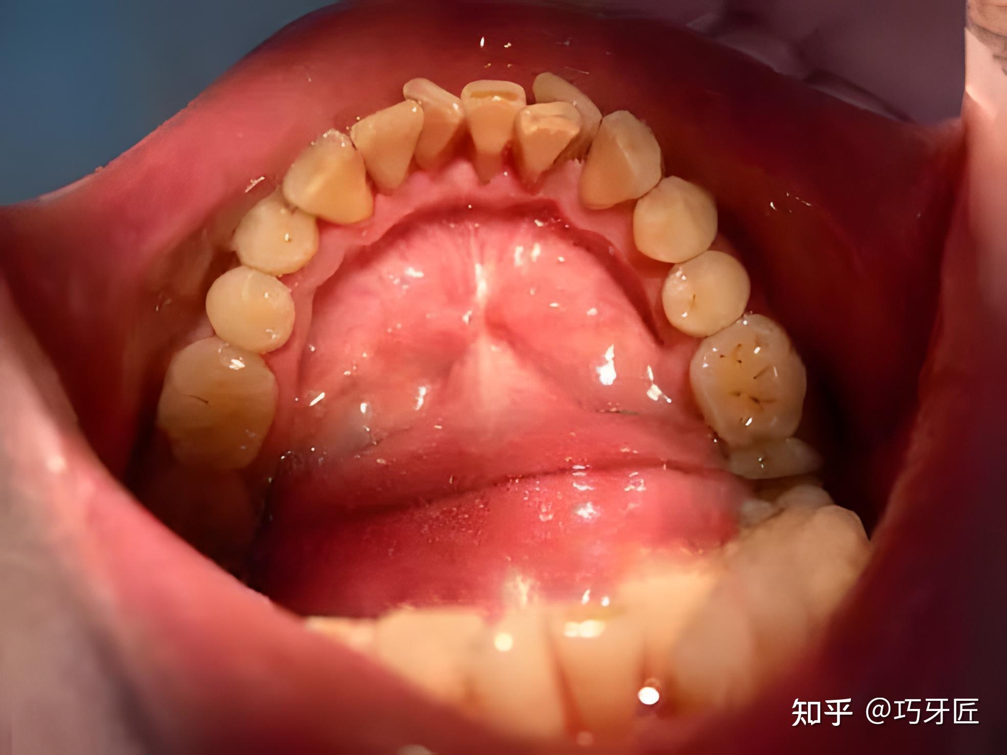 牙医必备收藏的图片合集口腔常见的疾病图片
