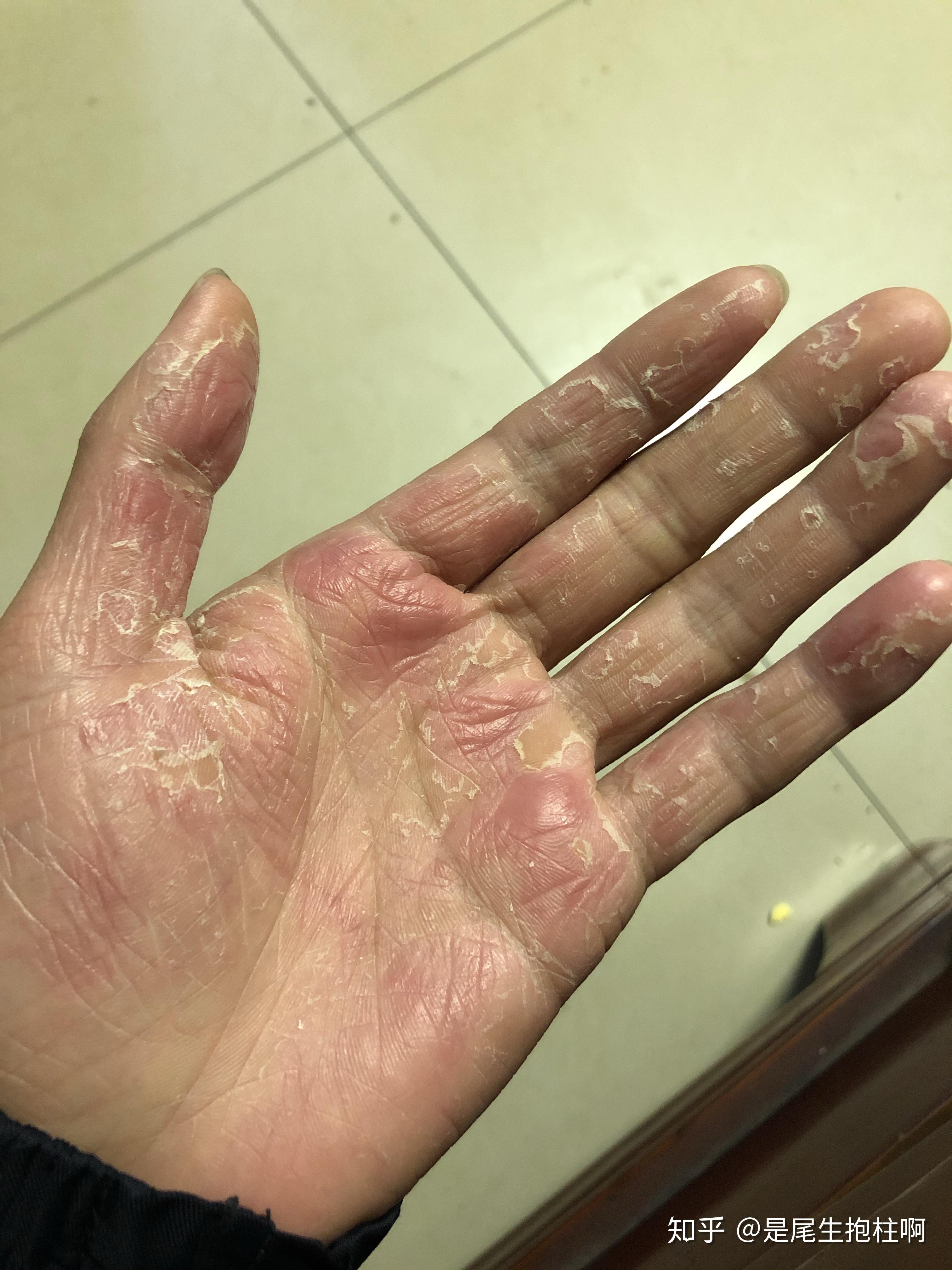 季节性手脱皮什么原因有什么方法可以根治吗