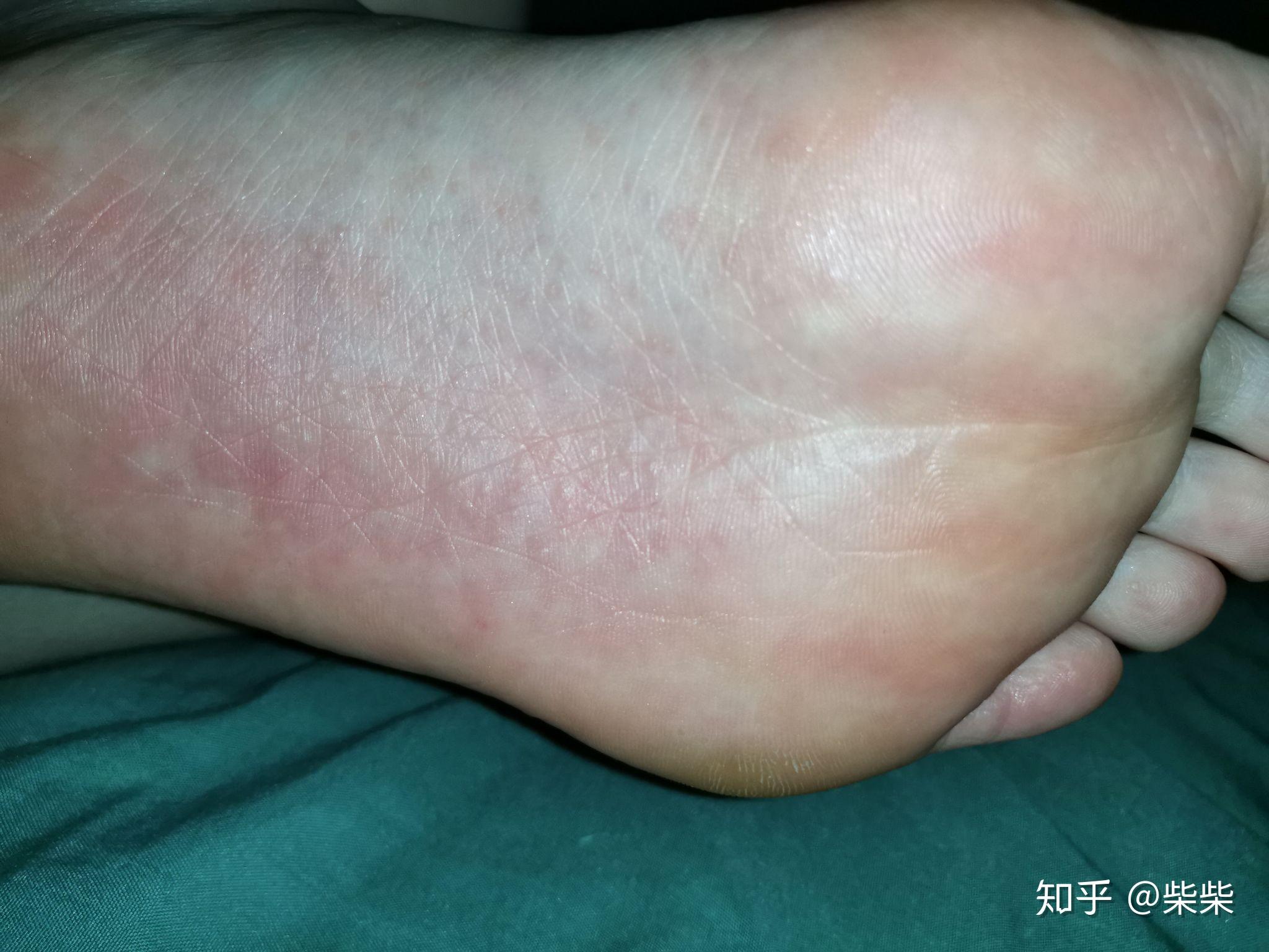 这脚底的东西是什么啊密密麻麻的还很痒请大神解答