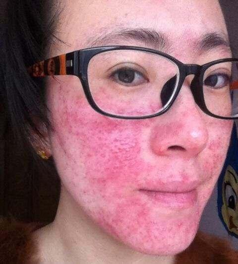 朵嘉浓海英:激素脸治疗过程中,这几个细节一定要注意,彻底治愈激素脸