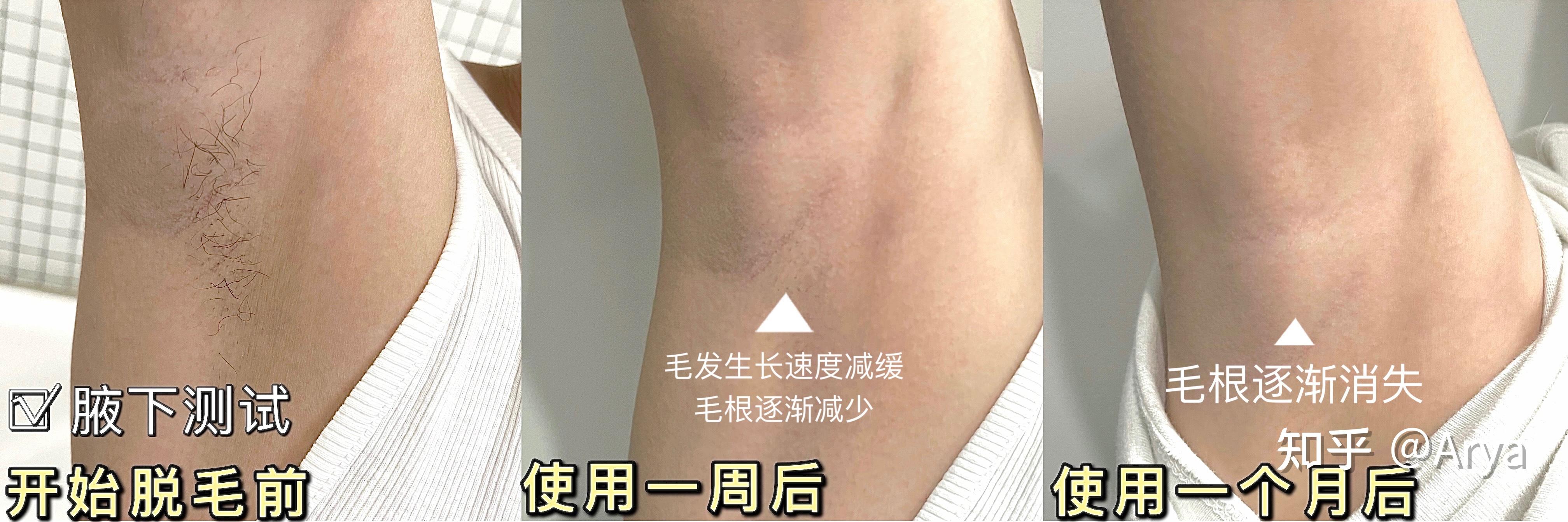 为什么明星剔完腋毛腋下的皮肤那么光滑?脱毛仪能做到吗? - 知乎