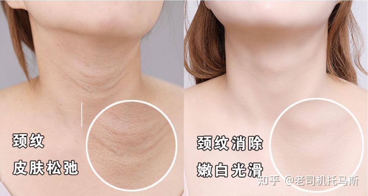 嗨体去颈纹到底有多好,效果能维持多久?