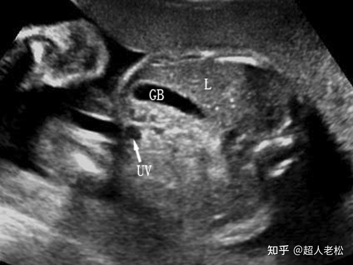 胎儿透明隔腔超声检查专家共识_Email