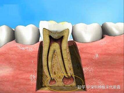 牙根发炎怎么办
