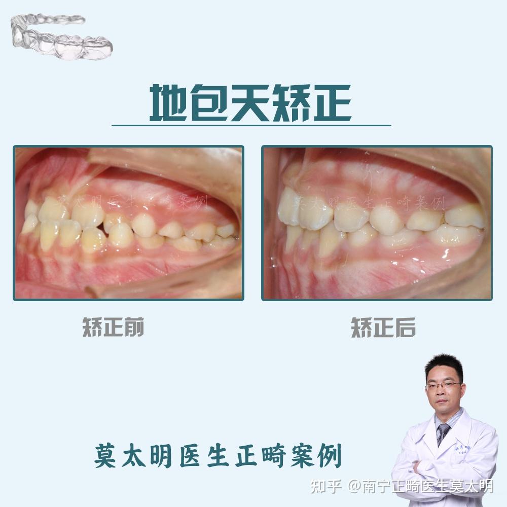 牙齒地包天長回來瞭如圖這樣需要再去矯正麼