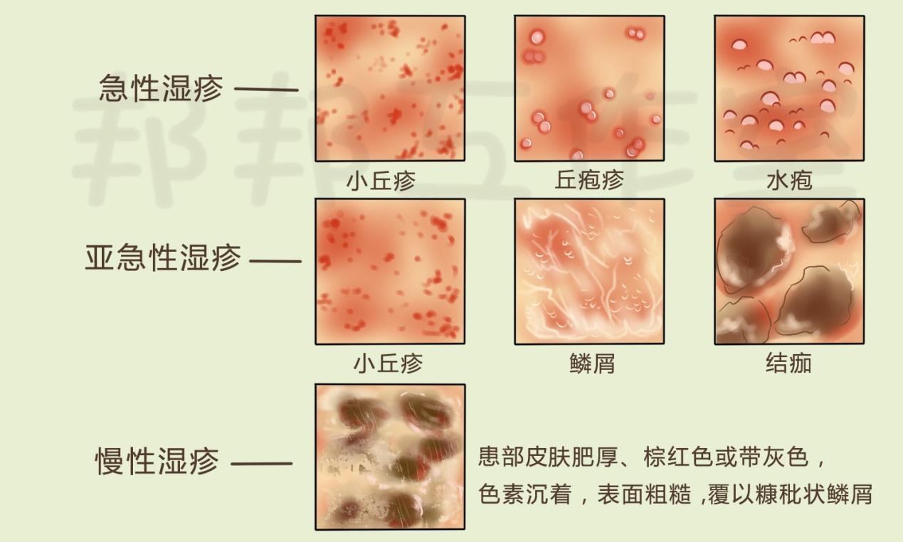 为什么会突然长湿疹？
