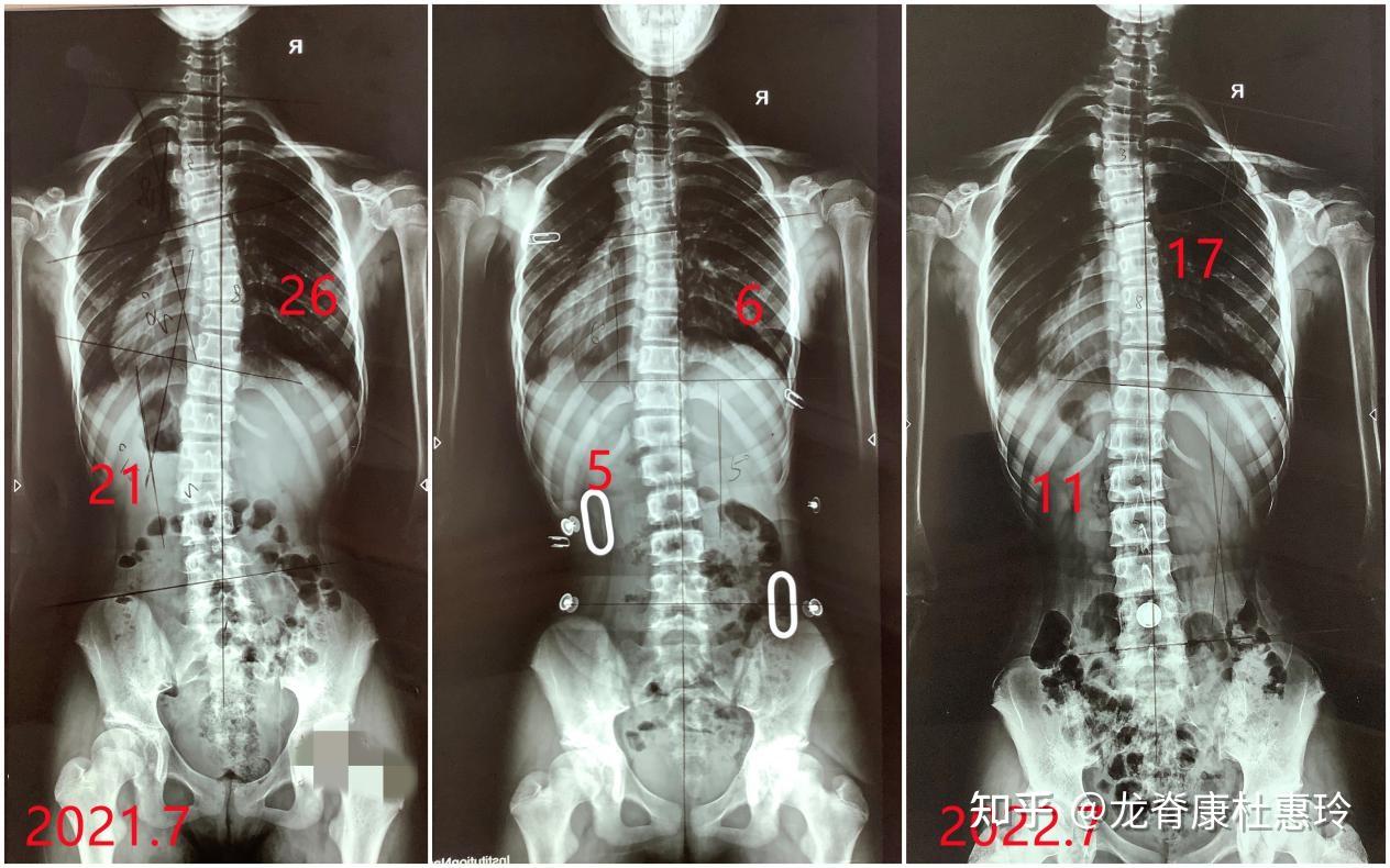 脊柱侧弯 新的儿童 脊柱侧弯 治疗技术 - Vejthani Hospital